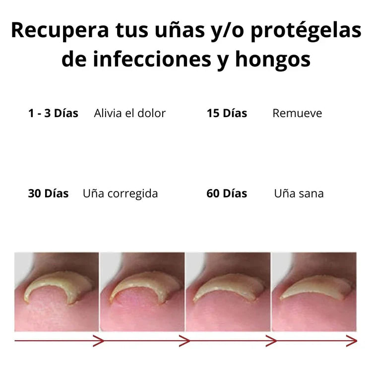 (2x1) Tratamiento para eliminar Hongos de uña 100% Natural🍃- LLEVE 2 Y PAGUE 1