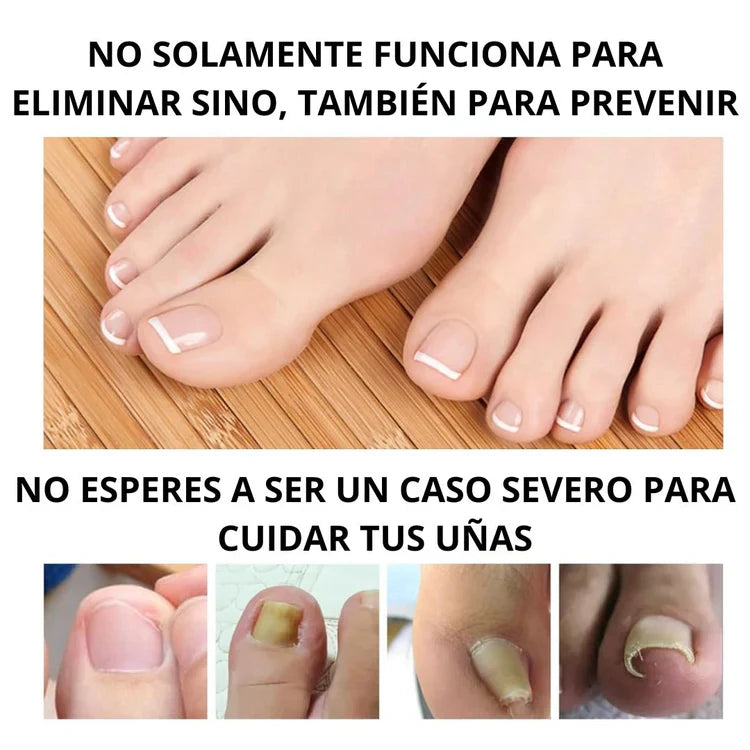 (2x1) Tratamiento para eliminar Hongos de uña 100% Natural🍃- LLEVE 2 Y PAGUE 1
